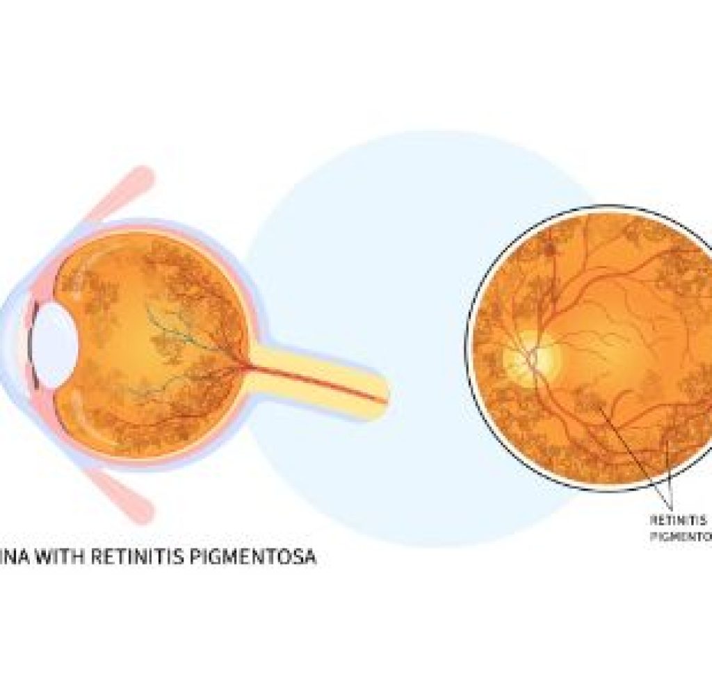 Retina Pigmentosa blog